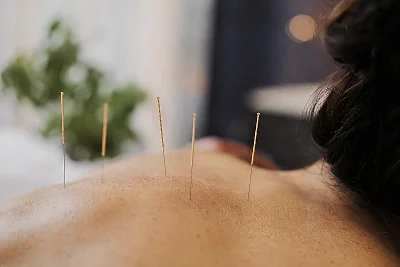 Acupuncture